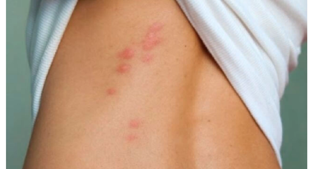 bed bug bites