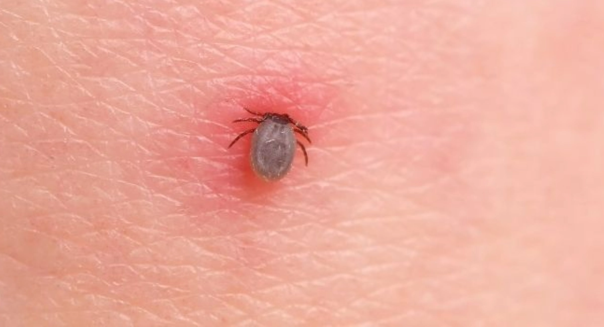 Ticks will get into human skin and spread diseases