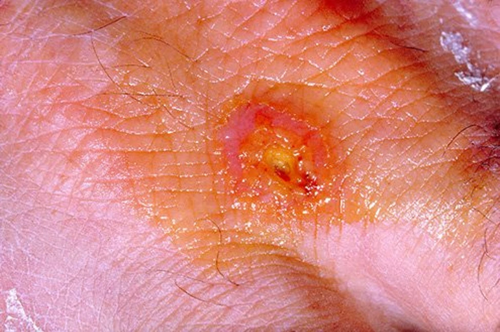 Tularemia Treatment